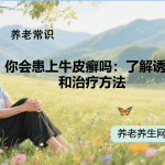 你会患上牛皮癣吗：了解诱因和治疗方法